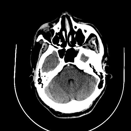 Chronic invasive fungal sinusitis (Radiopaedia 91563-109286 B 23).jpg