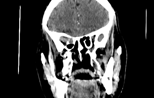 Chronic invasive fungal sinusitis (Radiopaedia 91563-109286 D 63).jpg