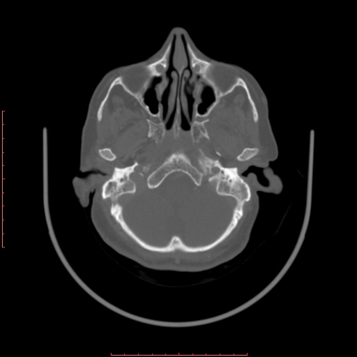 Chronic osteomyelitis - maxilla (Radiopaedia 23783-23927 Axial bone window 116).jpg