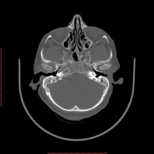 Chronic osteomyelitis - maxilla (Radiopaedia 23783-23927 Axial bone window 120).jpg