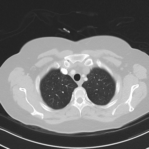 Chronic pulmonary embolus (Radiopaedia 39129-41341 Axial lung window 13).png