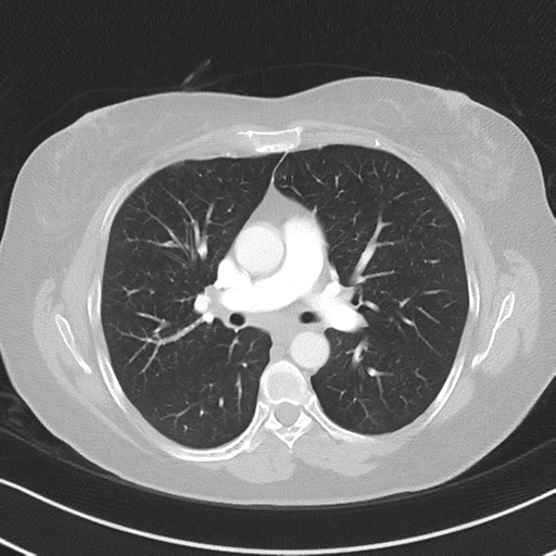 File:Chronic pulmonary embolus (Radiopaedia 39129-41341 Axial lung window 29).png