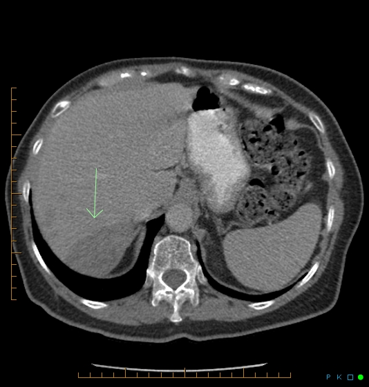File:Chronic right portal vein occlusion (Radiopaedia 26946-27124 A 1).jpg