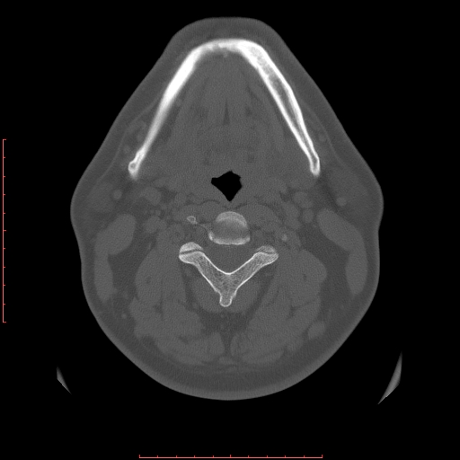 Chronic submandibular sialolithiasis (Radiopaedia 69817-79814 Axial bone window 78).jpg