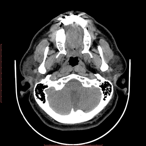 Chronic submandibular sialolithiasis (Radiopaedia 69817-79814 Axial non-contrast 34).jpg