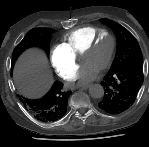 Chronic thromboembolic pulmonary disease (Radiopaedia 90694-108119 Axial C+ CTPA 64).jpg