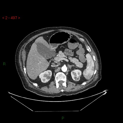 Circumaortic left renal vein and doubled left renal arteries (Radiopaedia 52268-58158 A 33).jpg