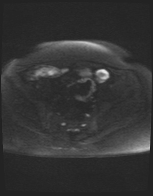 Class II Mullerian duct anomaly- unicornuate uterus with rudimentary horn and non-communicating cavity (Radiopaedia 39441-41755 Axial DWI 40).jpg