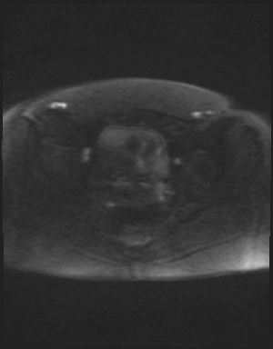 Class II Mullerian duct anomaly- unicornuate uterus with rudimentary horn and non-communicating cavity (Radiopaedia 39441-41755 Axial DWI 82).jpg