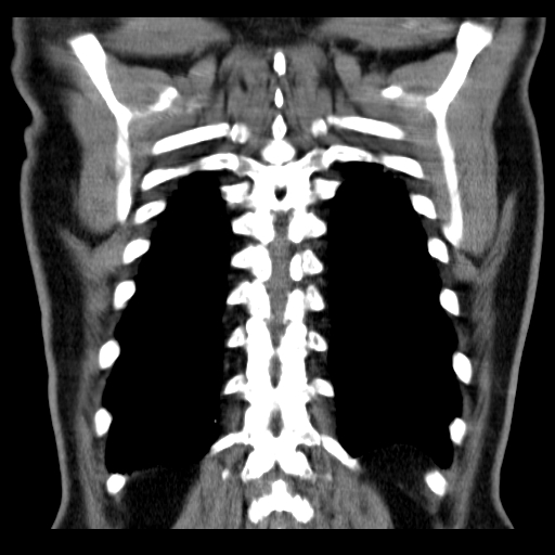 File:Classic complicated silicosis (Radiopaedia 49720-54961 Coronal liver window 54).jpg