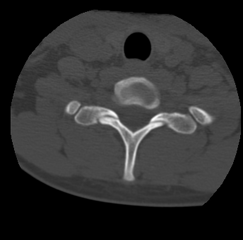 Clay-shoveler fracture (Radiopaedia 22568-22590 Axial bone window 64).jpg