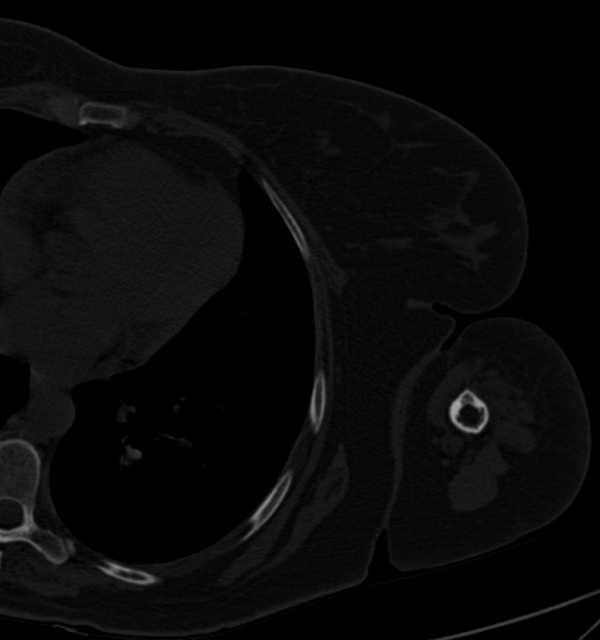 Clear cell chondrosarcoma - humerus (Radiopaedia 63104-71612 Axial bone window 102).jpg