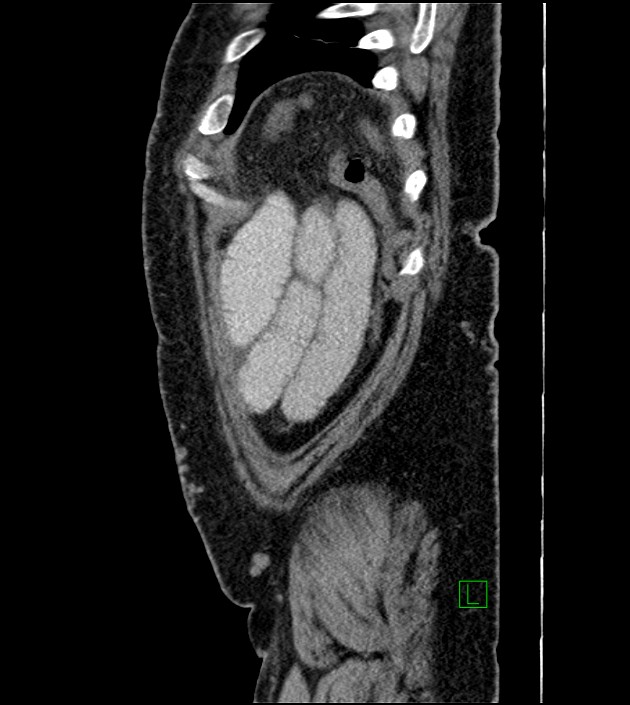 Closed-loop small bowel obstruction-internal hernia (Radiopaedia 78439-91096 C 25).jpg