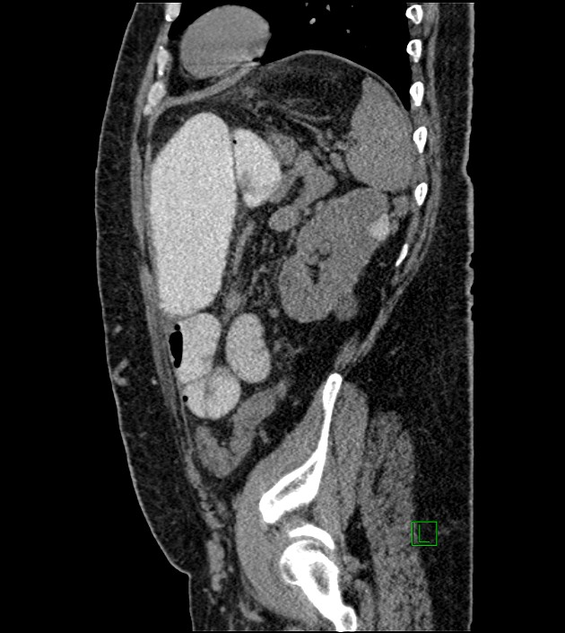 Closed-loop small bowel obstruction-internal hernia (Radiopaedia 78439-91096 C 43).jpg