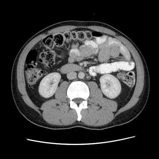 File:Closed-loop small bowel obstruction (Radiopaedia 73713-84509 A 78).jpg