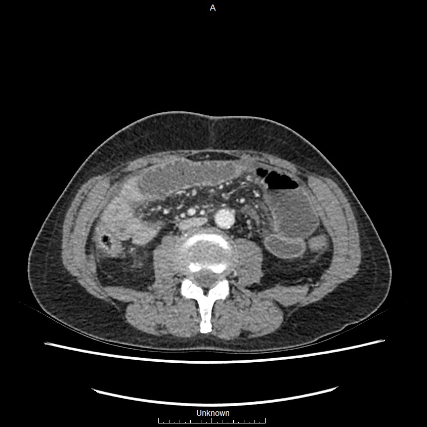 Closed loop bowel obstruction and ischemia (Radiopaedia 86959-103180 A 42).jpg