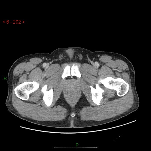 File:Closed loop obstruction and appendicular stump mucocele (Radiopaedia 54014-60163 A 123).jpg