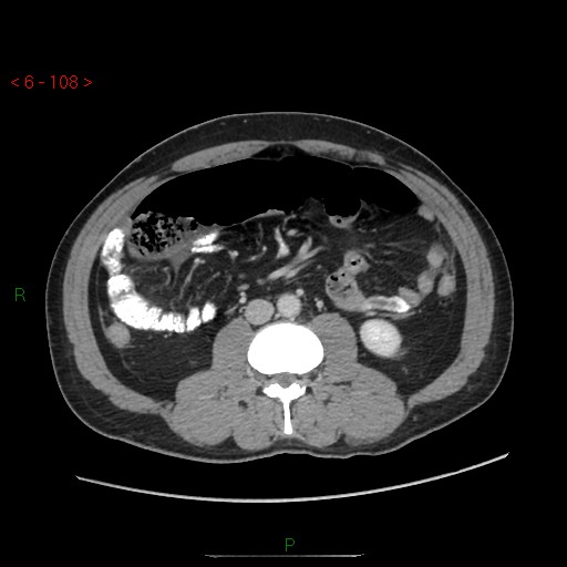 File:Closed loop obstruction and appendicular stump mucocele (Radiopaedia 54014-60163 A 60).jpg