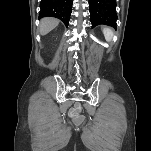Closed loop obstruction due to adhesive band, resulting in small bowel ischemia and resection (Radiopaedia 83835-99023 C 102).jpg