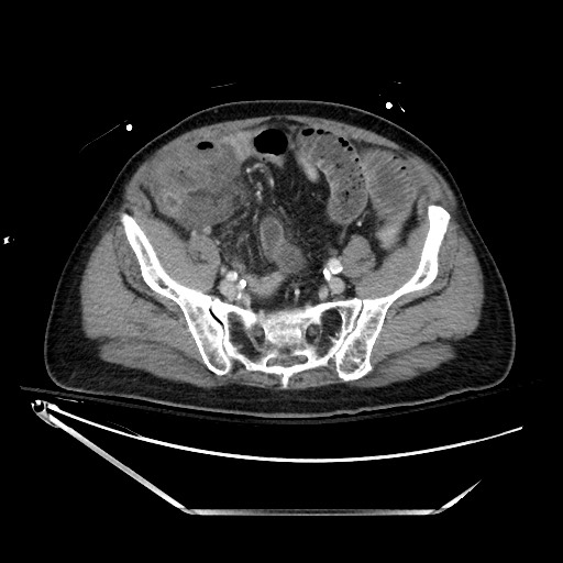 Closed loop obstruction due to adhesive band, resulting in small bowel ischemia and resection (Radiopaedia 83835-99023 D 117).jpg