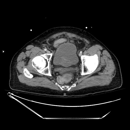 File:Closed loop obstruction due to adhesive band, resulting in small bowel ischemia and resection (Radiopaedia 83835-99023 D 141).jpg