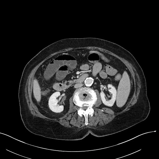 Closed loop small bowel obstruction - adhesions (Radiopaedia 59269-66611 A 58).jpg
