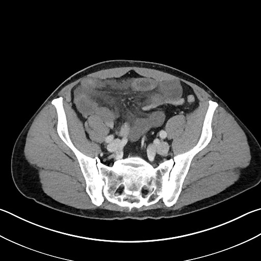 Closed loop small bowel obstruction - internal hernia (Radiopaedia 57806-64778 B 96).jpg