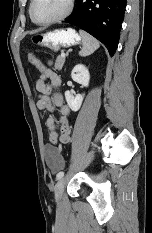 Closed loop small bowel obstruction - internal hernia (Radiopaedia 57806-64778 C 38).jpg