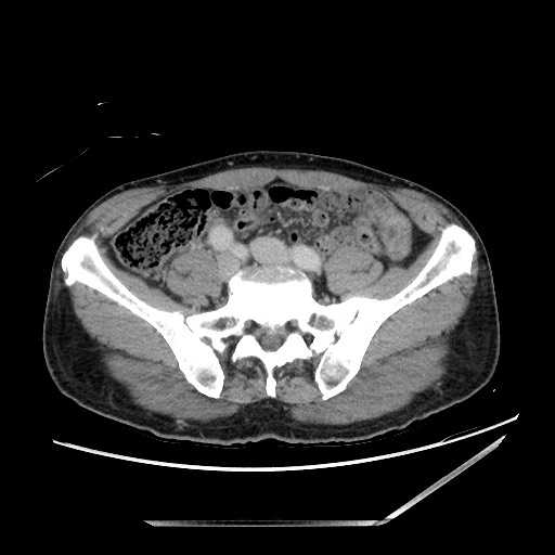 Closed loop small bowel obstruction - omental adhesion causing "internal hernia" (Radiopaedia 85129-100682 A 119).jpg