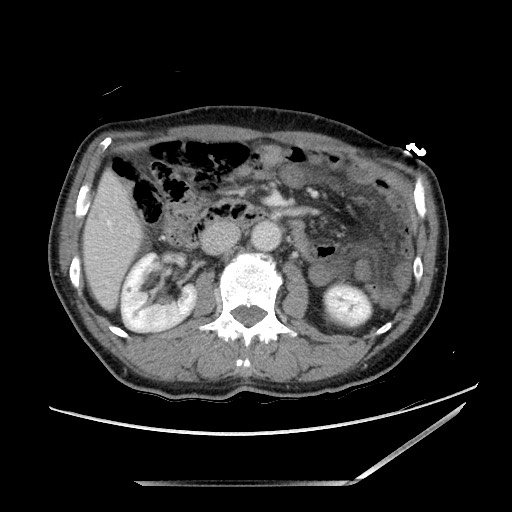 Closed loop small bowel obstruction - omental adhesion causing "internal hernia" (Radiopaedia 85129-100682 A 68).jpg