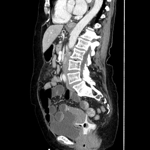 Closed loop small bowel obstruction due to adhesive band, with intramural hemorrhage and ischemia (Radiopaedia 83831-99017 D 108).jpg