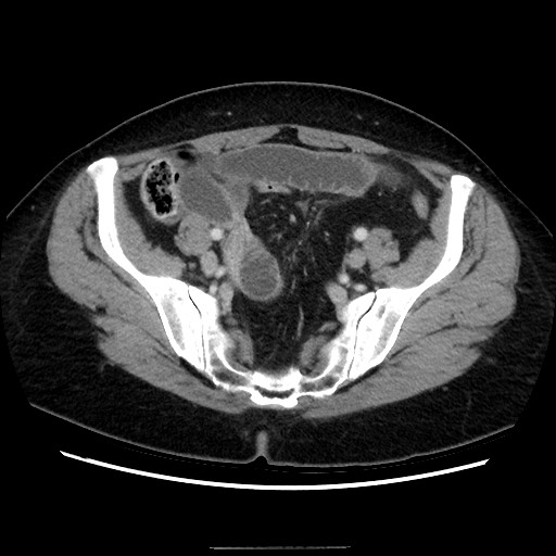 Closed loop small bowel obstruction due to adhesive bands - early and late images (Radiopaedia 83830-99015 A 129).jpg