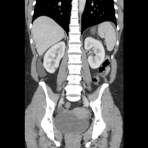 File:Closed loop small bowel obstruction due to trans-omental herniation (Radiopaedia 35593-37109 B 36).jpg