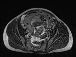 Closed loop small bowel obstruction in pregnancy (MRI) (Radiopaedia 87637-104031 D 25).jpg
