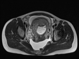 Closed loop small bowel obstruction in pregnancy (MRI) (Radiopaedia 87637-104031 D 31).jpg