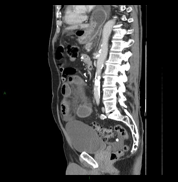 Closed loop small bowel obstruction with ischemia (Radiopaedia 84180-99456 C 52).jpg
