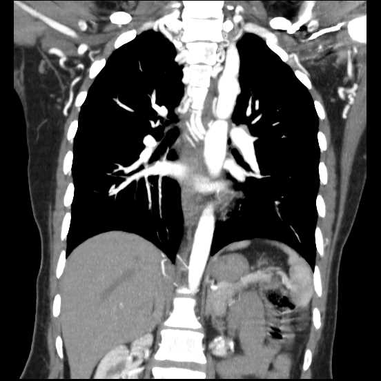 File:Coarctation of the aorta (Radiopaedia 67609-77010 B 29).jpg