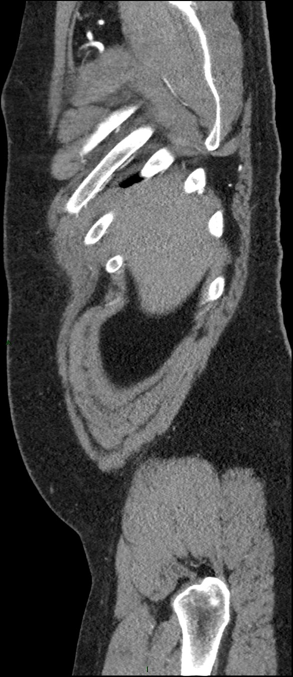 Coarctation of the aorta (Radiopaedia 74632-88521 C 21).jpg