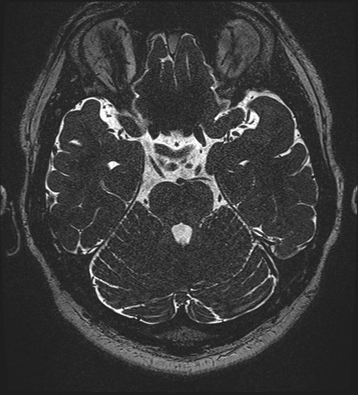 Cochlear incomplete partition type III associated with hypothalamic hamartoma (Radiopaedia 88756-105498 Axial T2 120).jpg