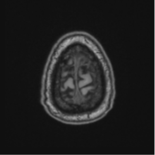 File:Colloid cyst of the third ventricle (Radiopaedia 86571-102662 Axial T1 71).png
