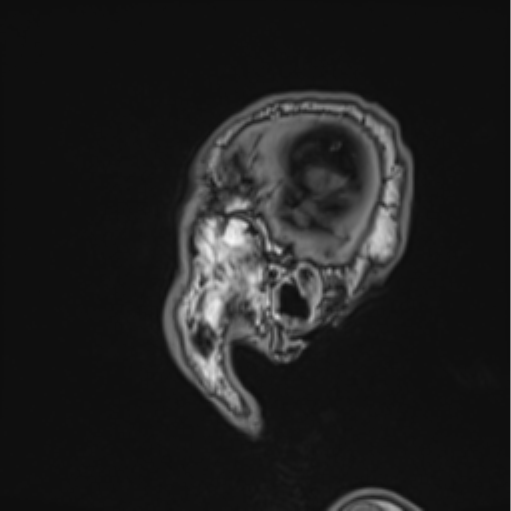 Colloid cyst of the third ventricle (Radiopaedia 86571-102662 Sagittal T1 6).png