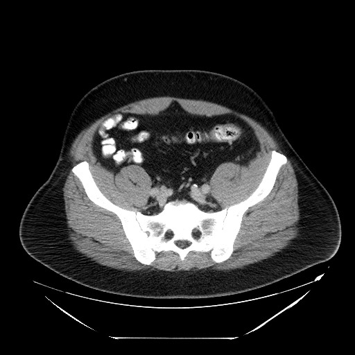 Colocolic intussusception due to lipoma (Radiopaedia 73712-84508 A 90).jpg