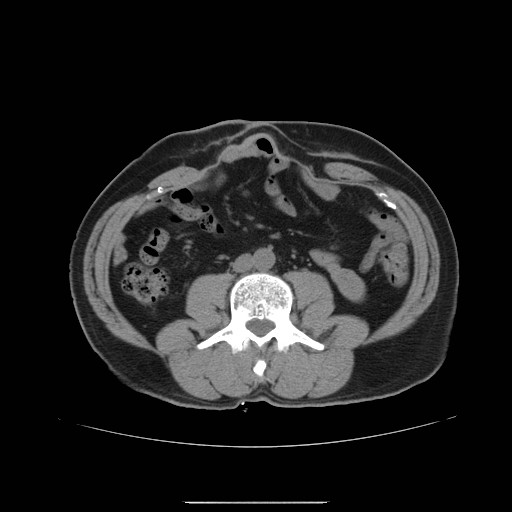 File:Colocutaneous fistula in Crohn's disease (Radiopaedia 29586-30093 Axial non-contrast 9).jpg