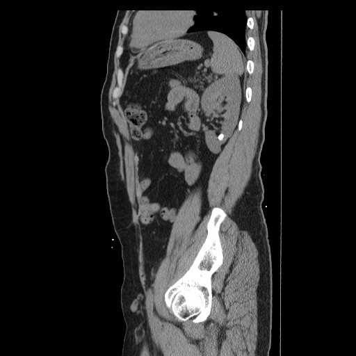 File:Colocutaneous fistula in Crohn's disease (Radiopaedia 29586-30093 C 45).jpg