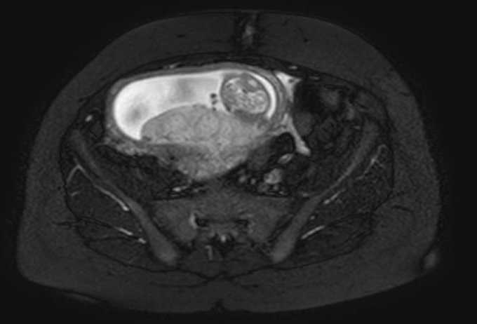File:Colon adenocarcinoma with Krukenberg tumors, advanced pregnancy (Radiopaedia 67279-76645 Axial T2 SPAIR 23).jpg