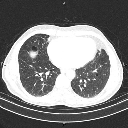 File:Colon cancer (Radiopaedia 85663-101443 Axial lung window 44).jpg