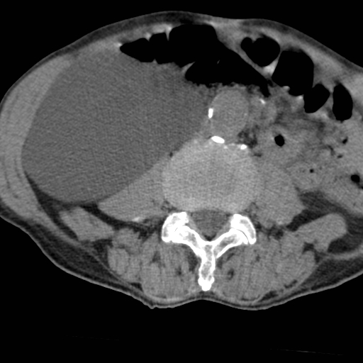Colon cancer with calcified liver metastasis (Radiopaedia 74423-85309 Axial non-contrast 57).jpg