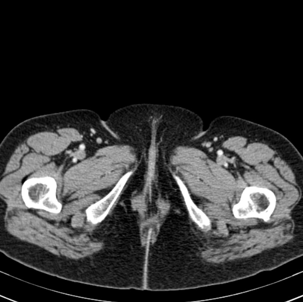 Colon carcinoma with hepatic metastases (Radiopaedia 29477-29961 A 128).jpg