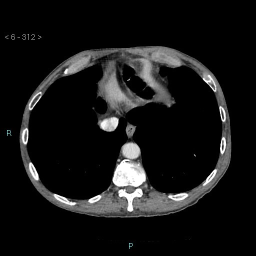 File:Colonic cancer (ultrasound and TC imaging) (Radiopaedia 50346-55713 B 312).jpg