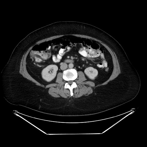 File:Colonic intussusception due to adenocarcinoma (Radiopaedia 86828-102987 A 76).jpg